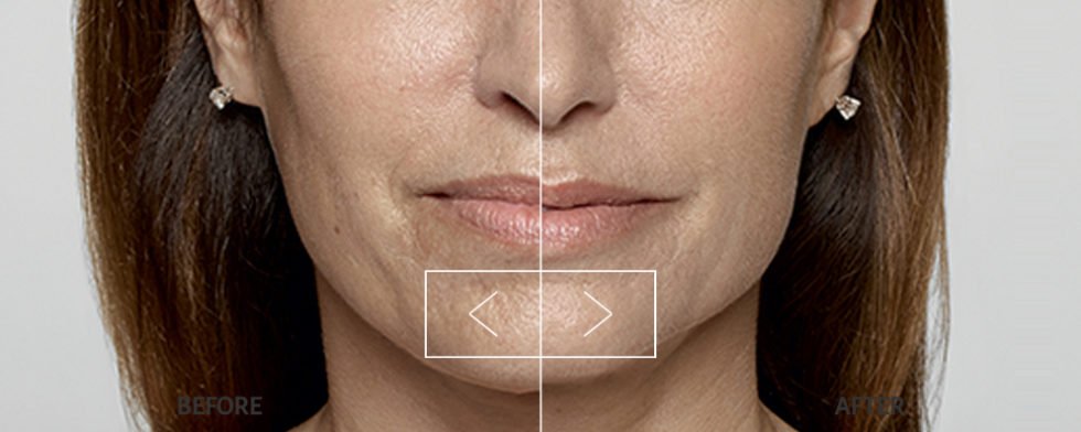 Restylane Reflect Medical Cosmetic Center