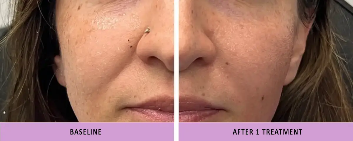 triLift, Facial Muscle Stimulation, Facial toning, non-surgical face lift, face lifting, cheekbone lift